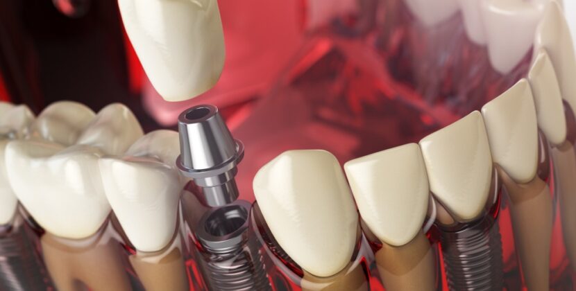 Implanty stomatologiczne – 6 powodów, by wybrać tę metodę uzupełnienia braków zębowych